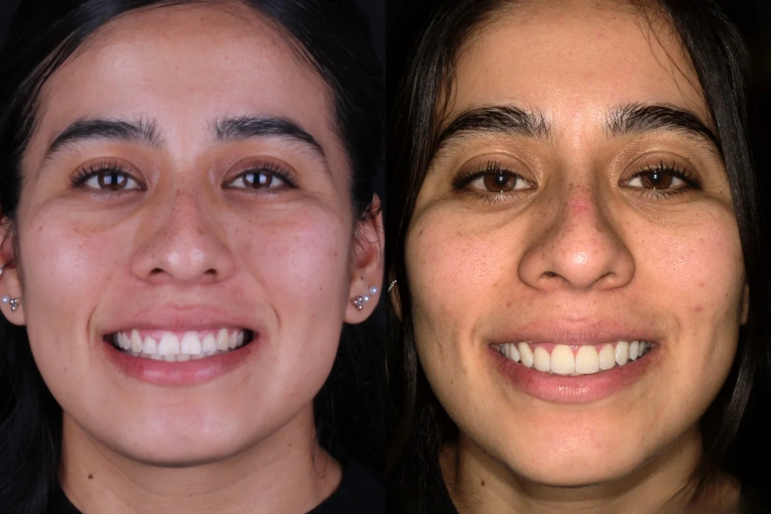 Patient smiling with ceramic veneers from Perfect Smile Dental in Tijuana