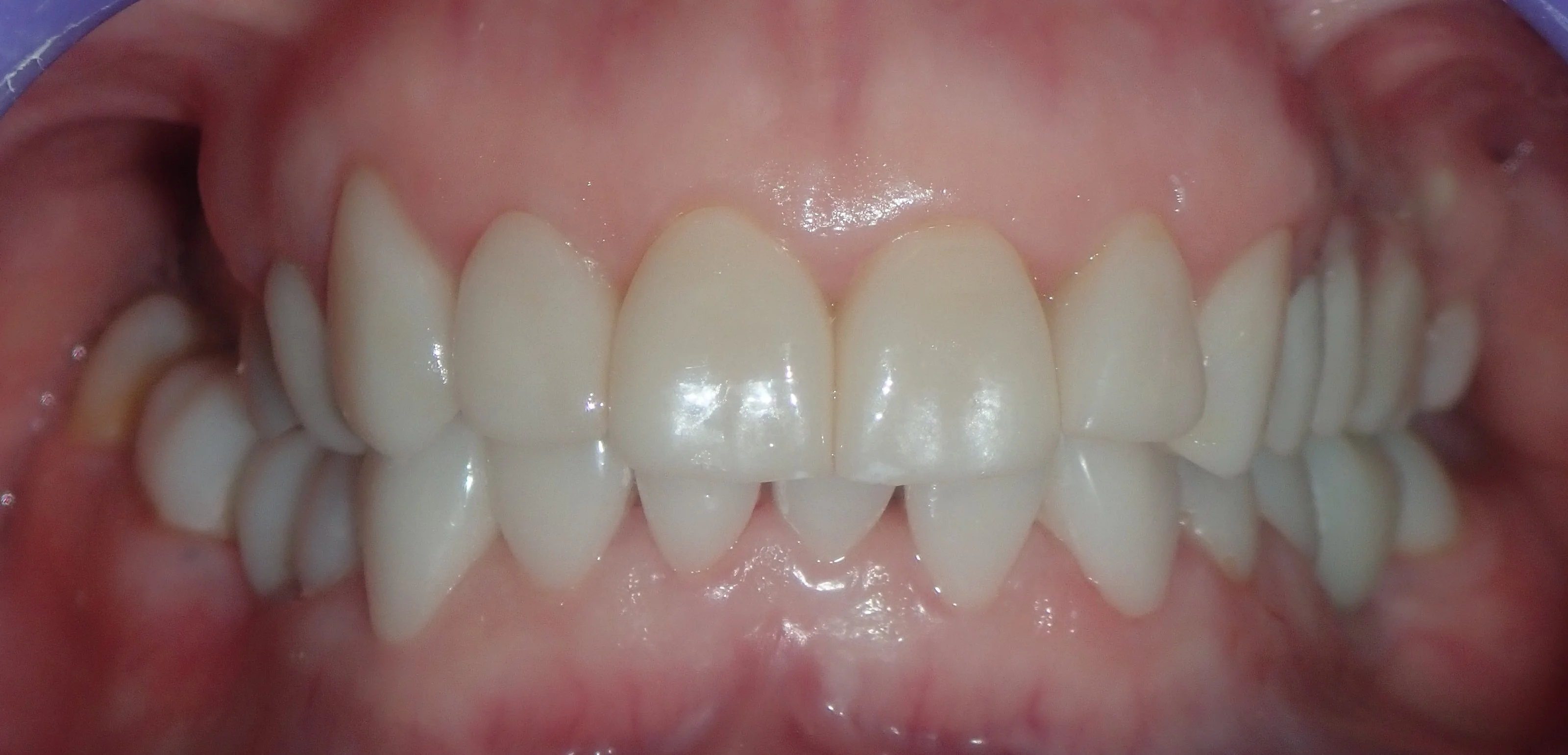 The same patient with their ceramic veneers