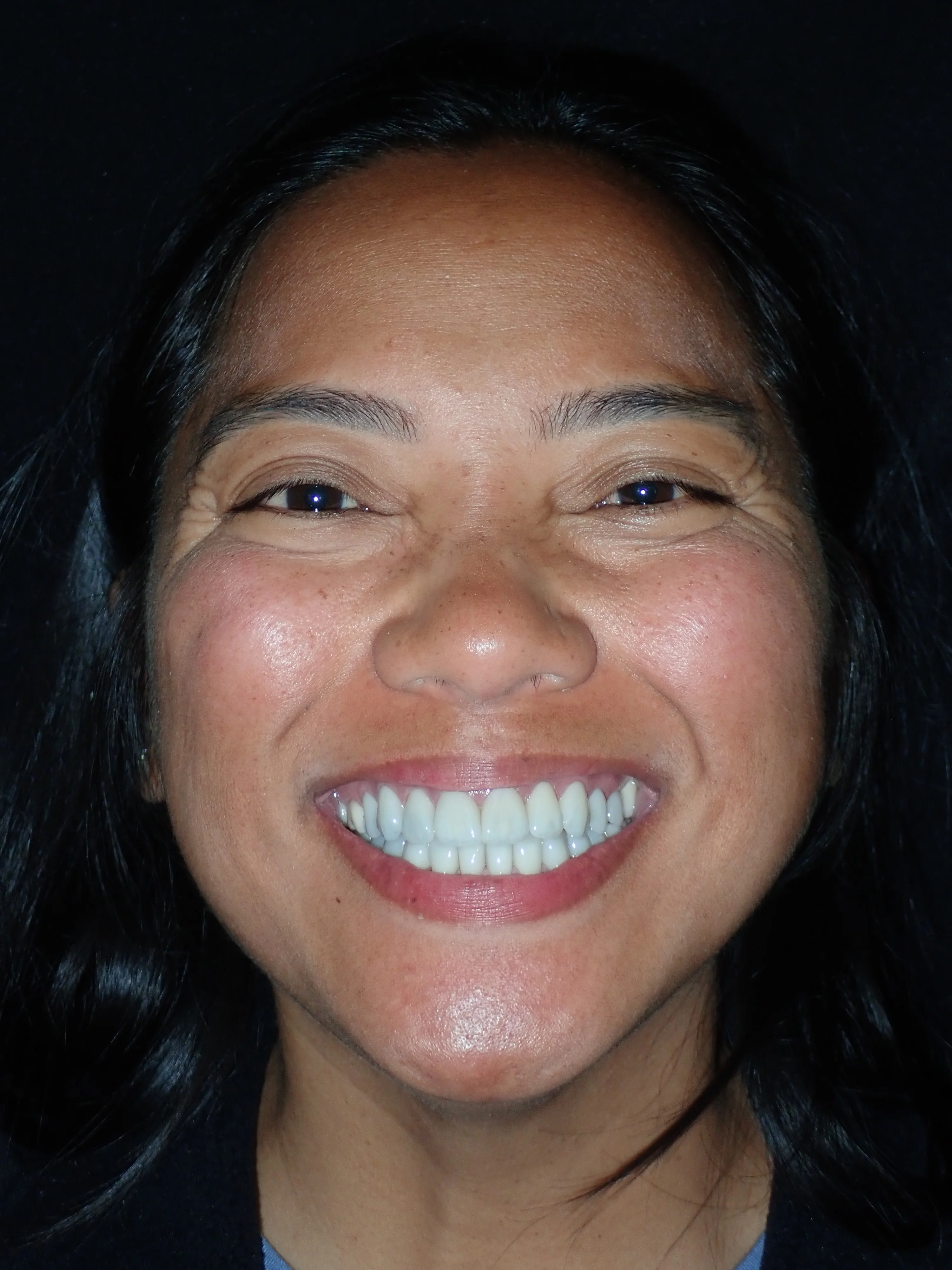 The same patient with their ceramic veneers