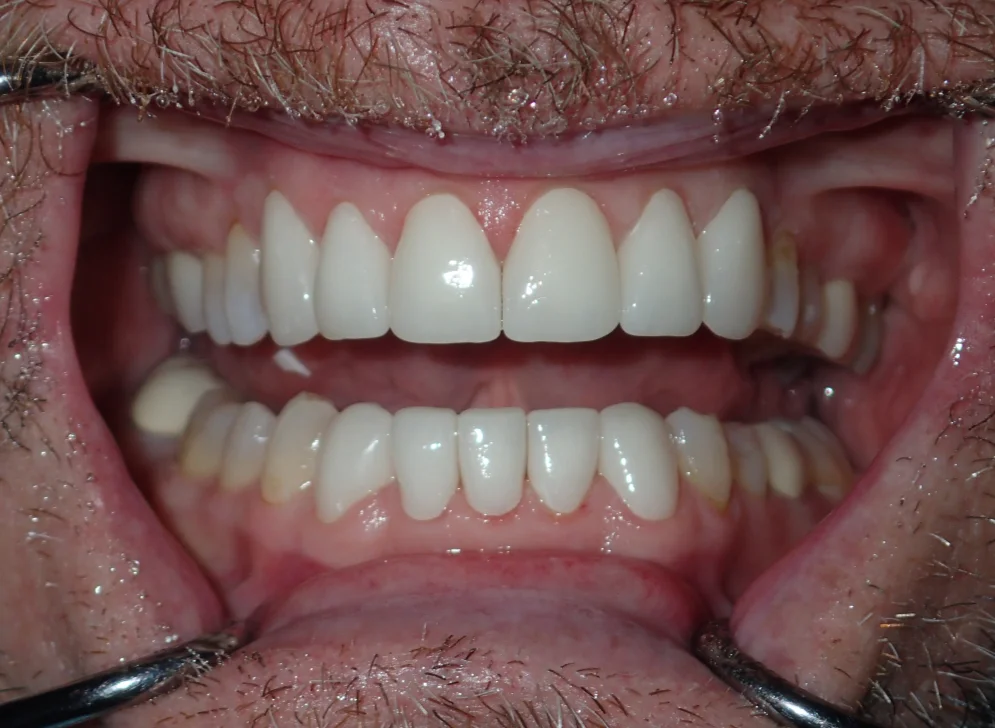 The same patient with their ceramic veneers