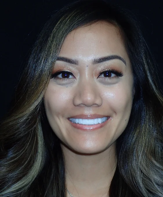 The same patient with their ceramic veneers