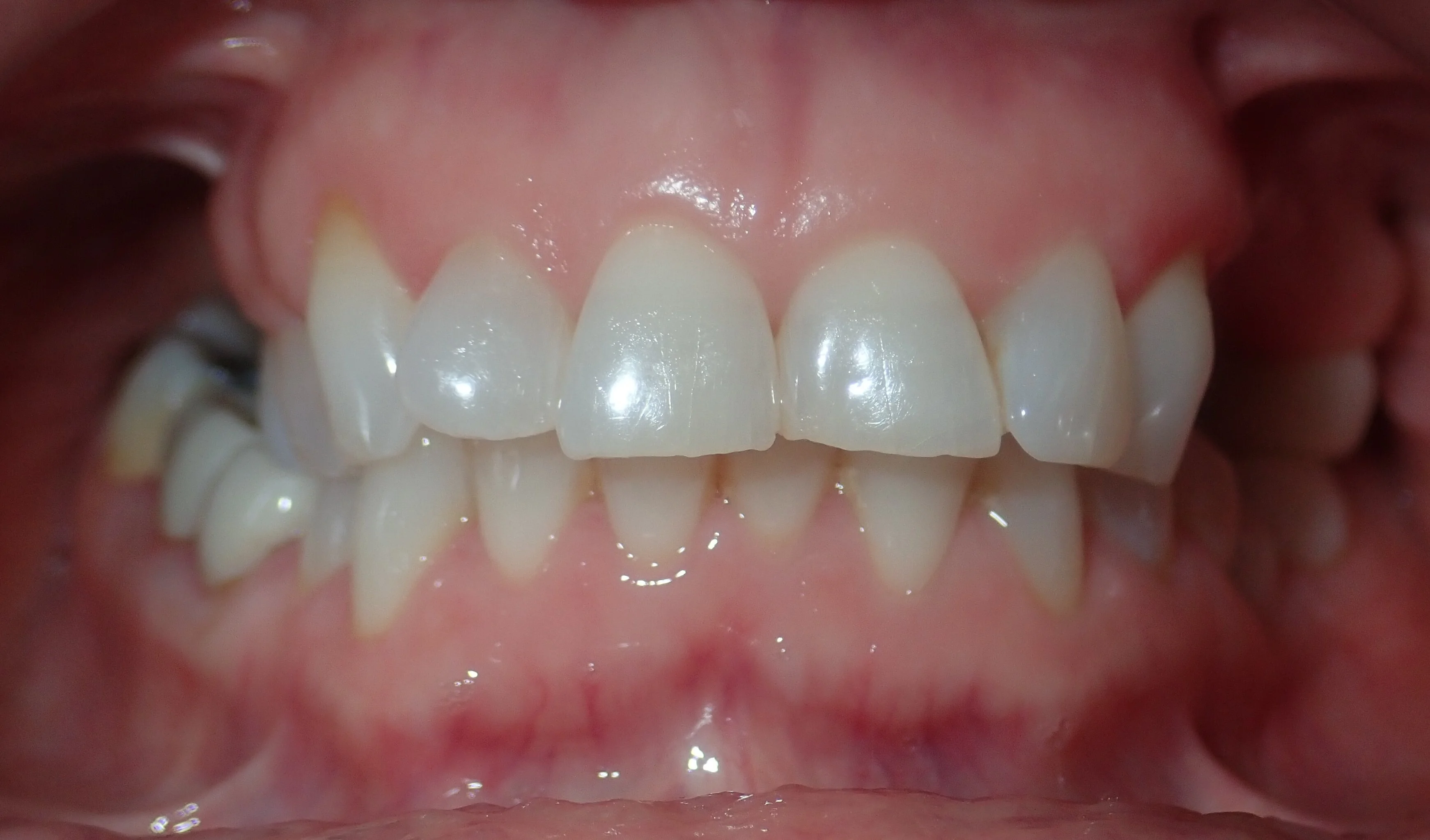 Patient before their ceramic veneers