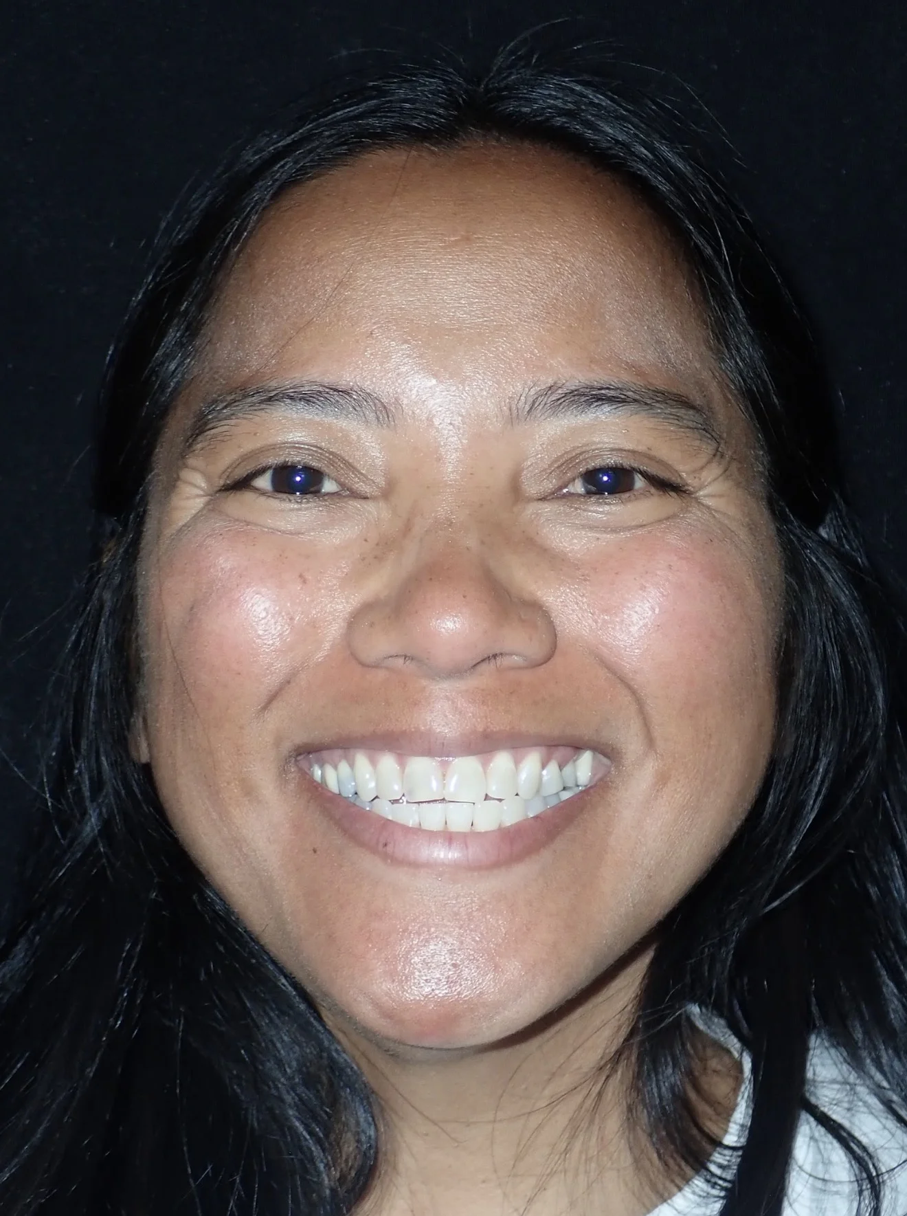 Patient before their ceramic veneers