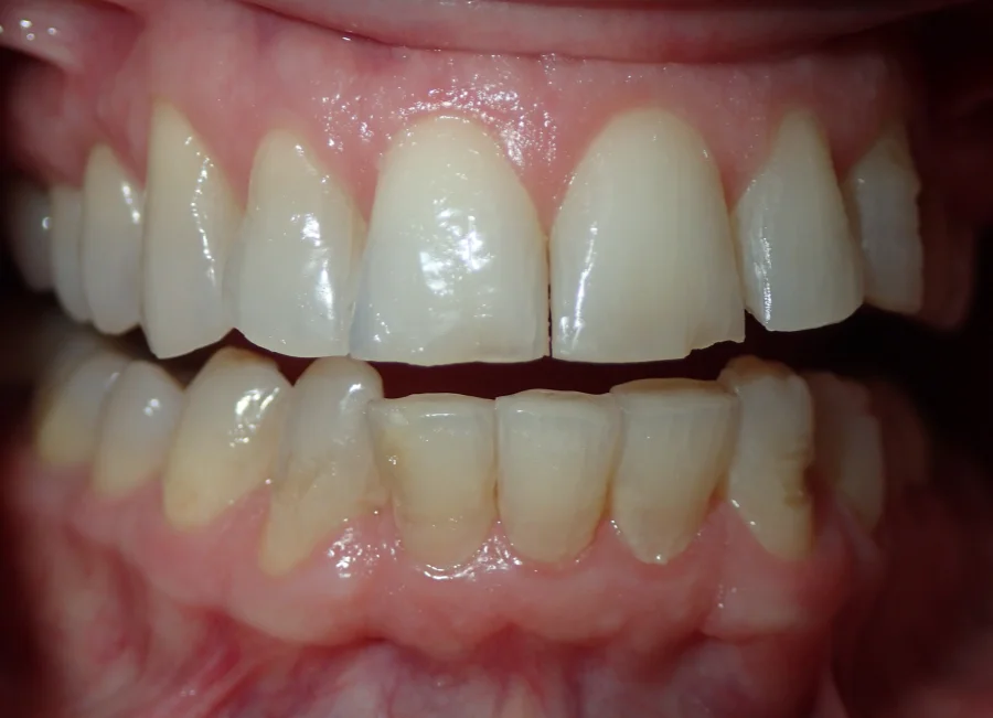 Patient before their ceramic veneers