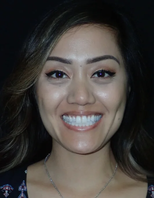 Patient before their ceramic veneers